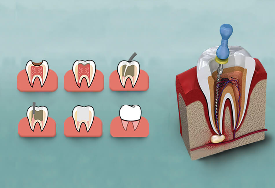 Bali Root Canal Treatment