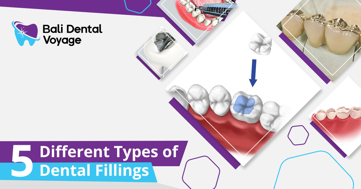 What Are the 5 Types of Filling