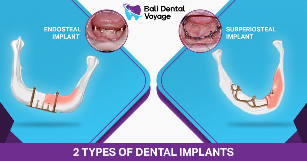 2 Types of Dental Implants - Dental Implants Types