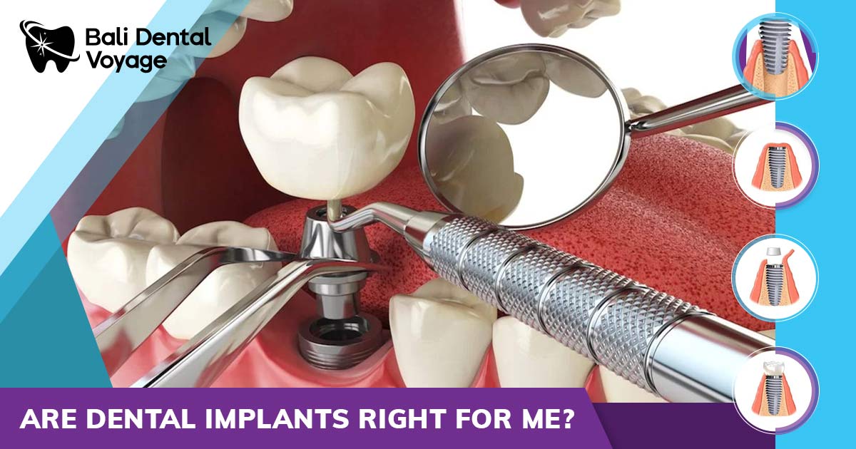are dental implants right for me