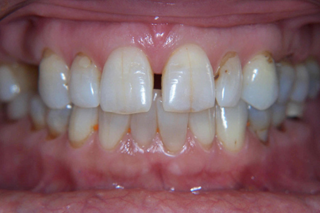 diastema or gap teeth diagnosis and evaluation