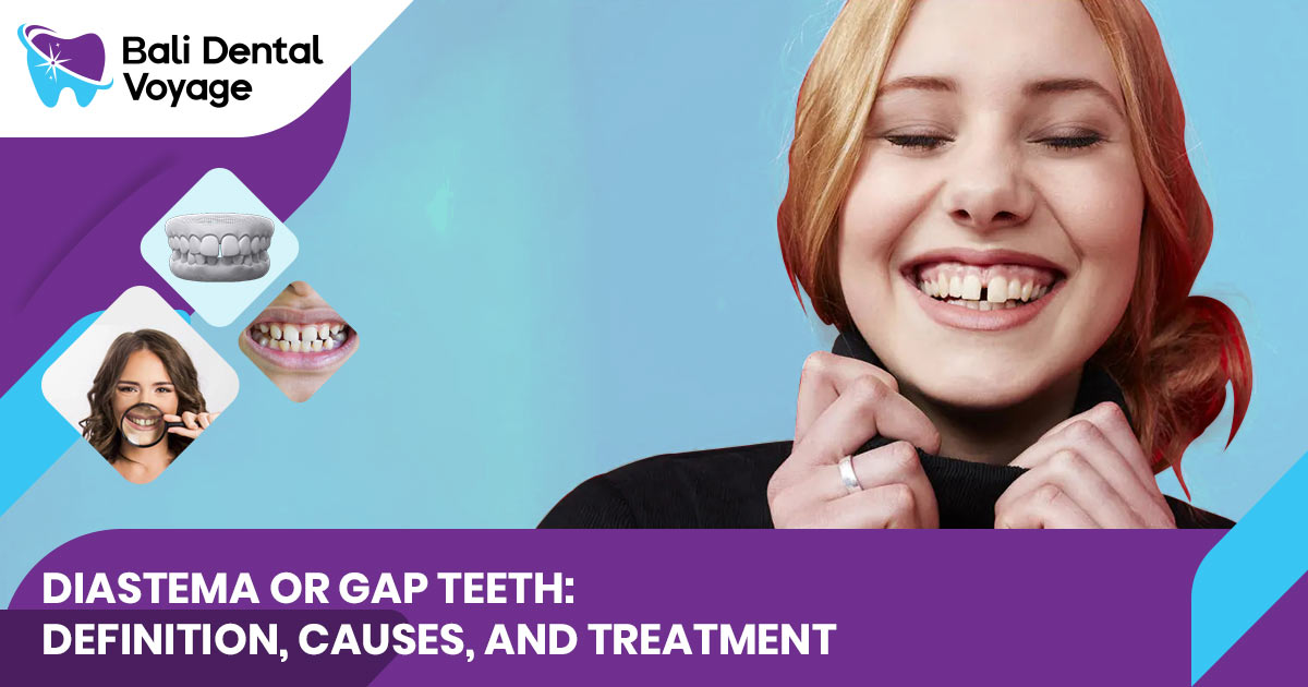 diastema or gap teeth