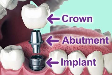 Dental Implant Procedure: What to Expect on the Treatment?