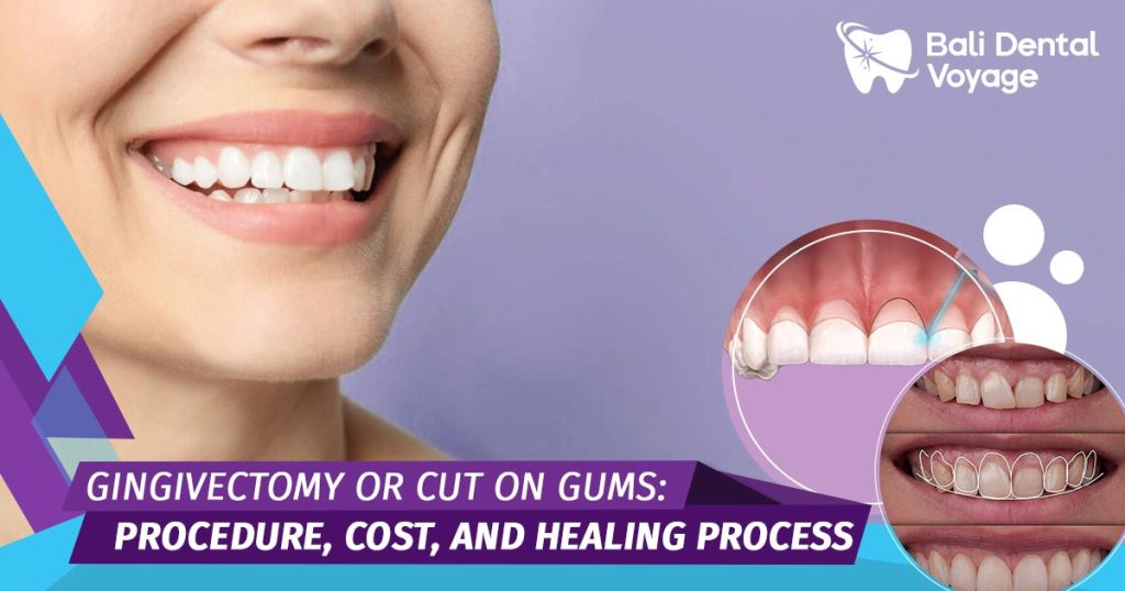 Gingivectomy Cost Healing Process And The Procedure