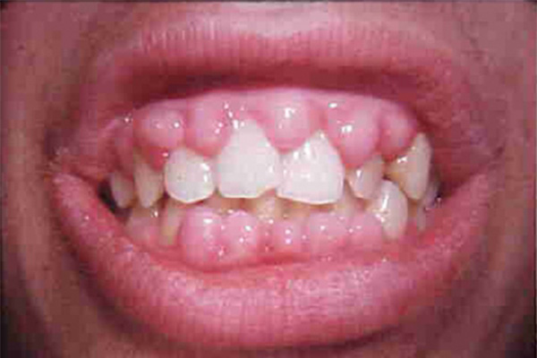 Gum Disease Symptoms