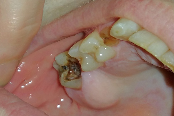 Tooth Abscess Antibiotics