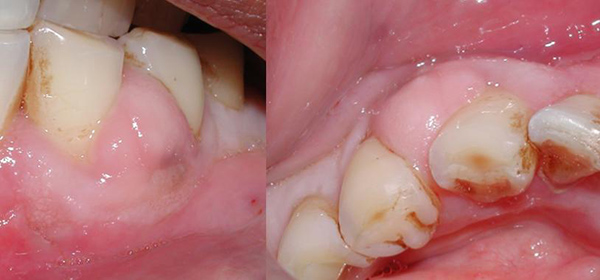 Tooth Abscess Treatment