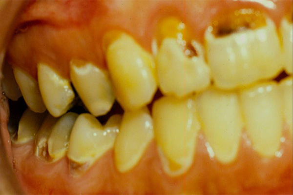 Tooth Decay Symptoms