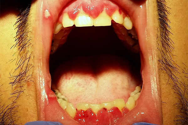 What Does Gum Disease Look Like