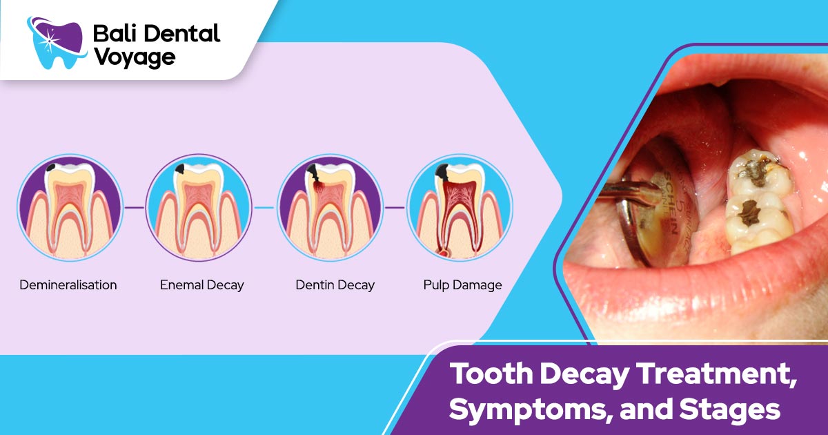 Tooth Decay Treatment, Symptoms, and Stages