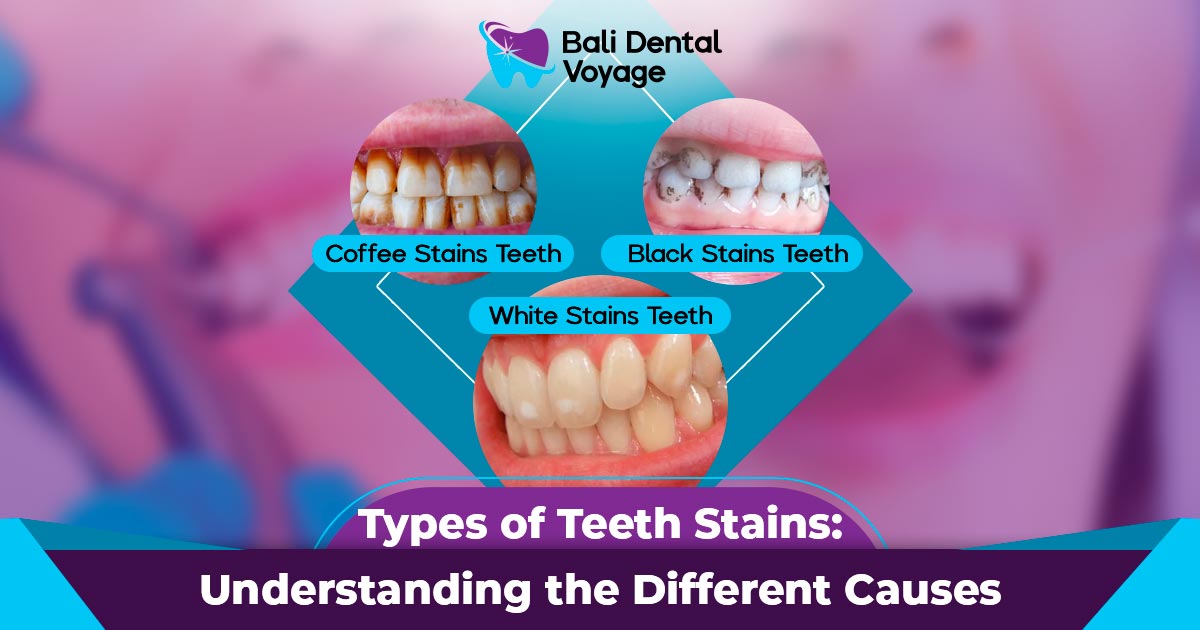 stained teeth - types of teeth stains