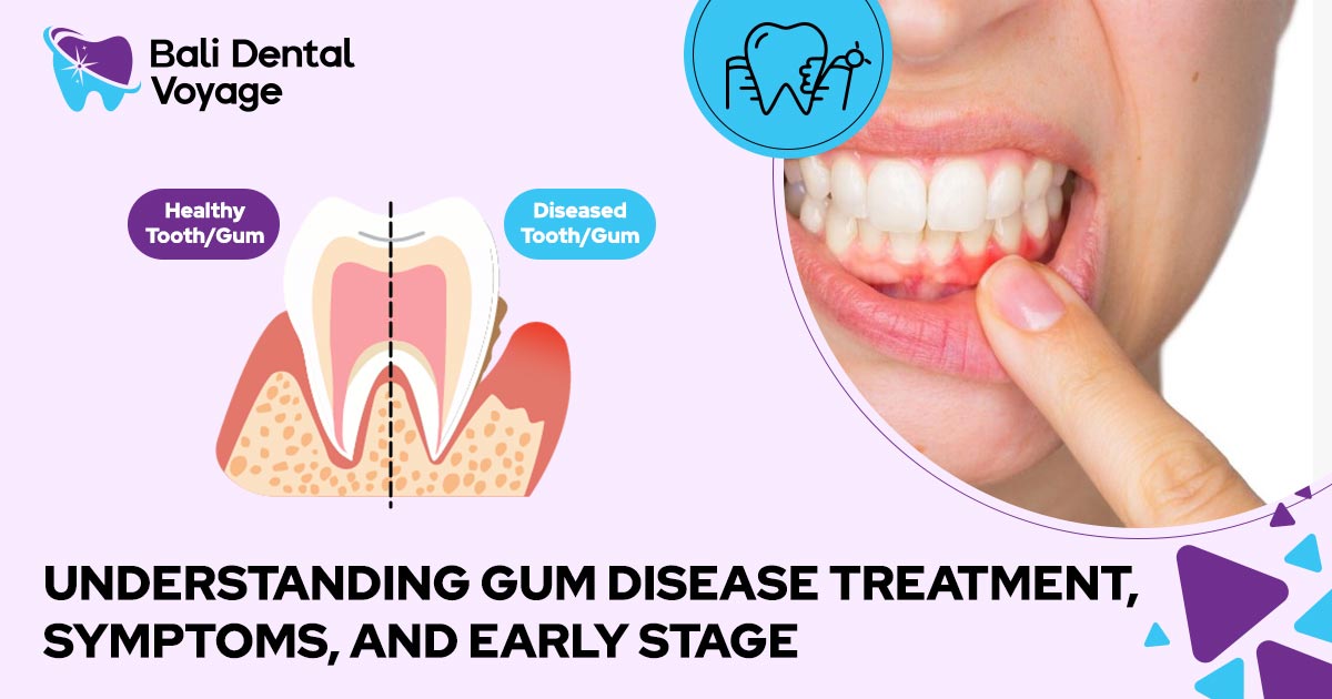 Gum Disease Treatment, Symptoms, and Early Stage