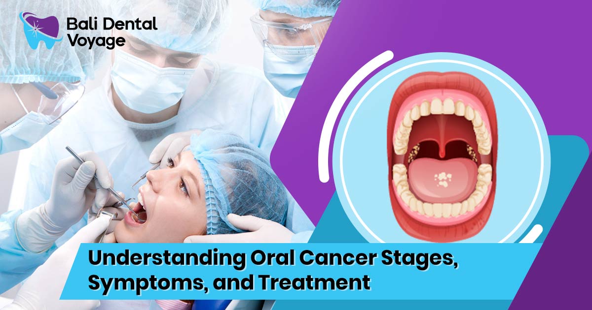 Oral Cancer Stages, Symptoms, and Treatment