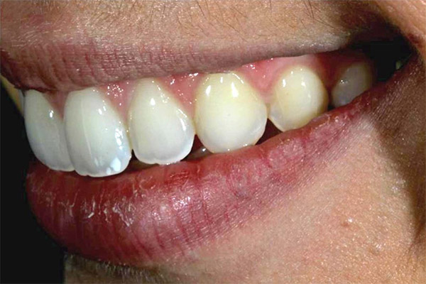 Remove Calculus From Teeth