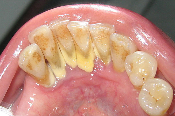 Signs of Tartar Buildup on Teeth