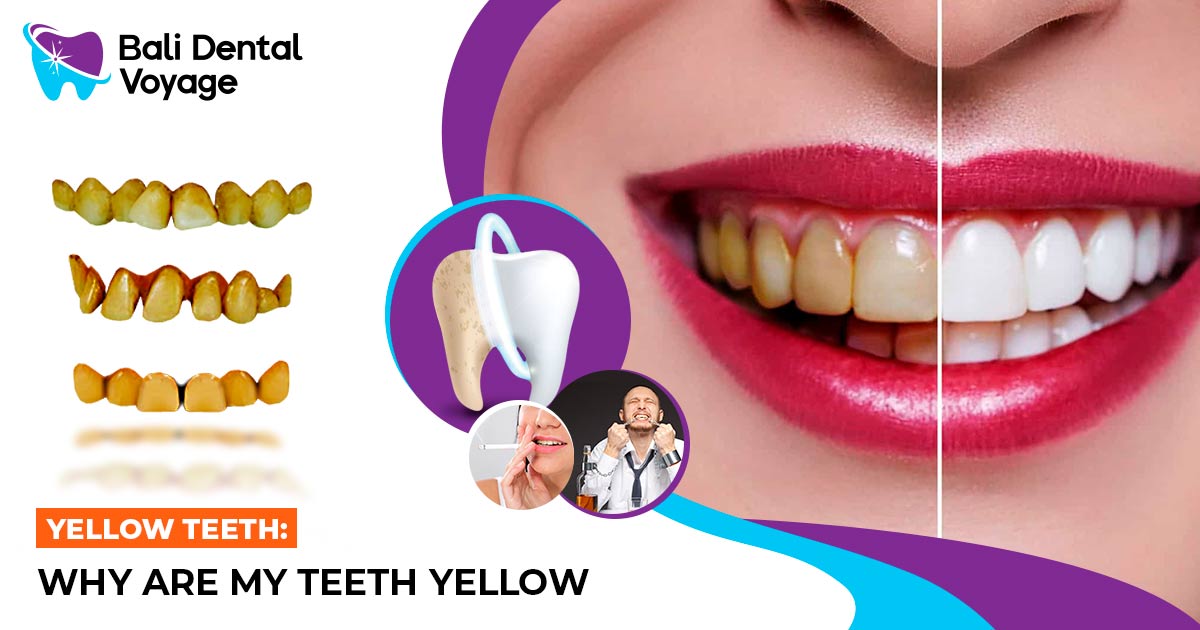 Yellow Teeth: Why Are My Teeth Yellow