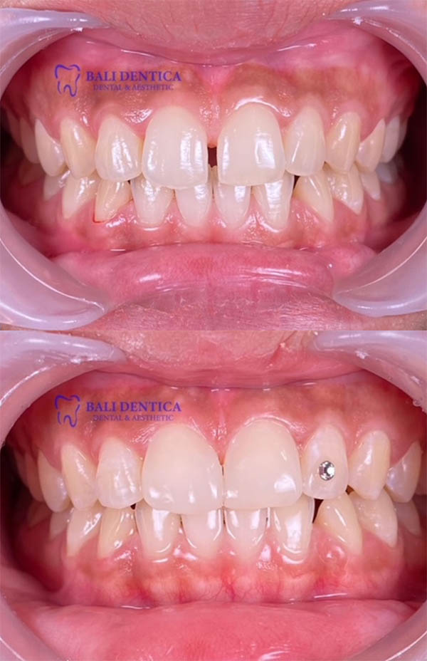 Cosmetic Dentistry Results 1