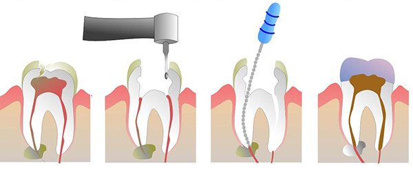 Tooth Infection Treatment