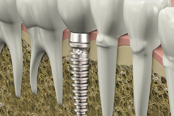 Treatment of Missing Teeth