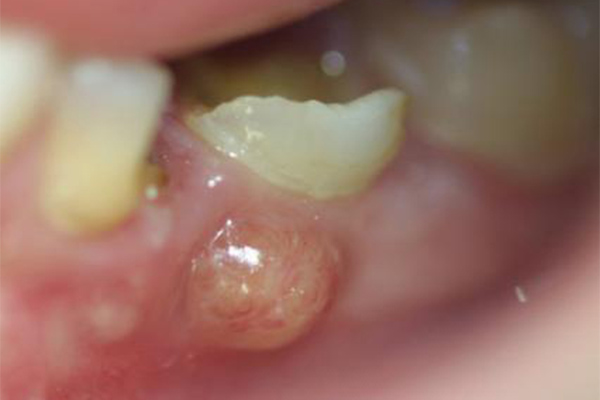 Health Risks of Root Canal Diseases