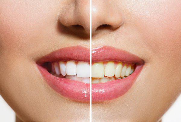 Treatment Options for Tooth Discolouration