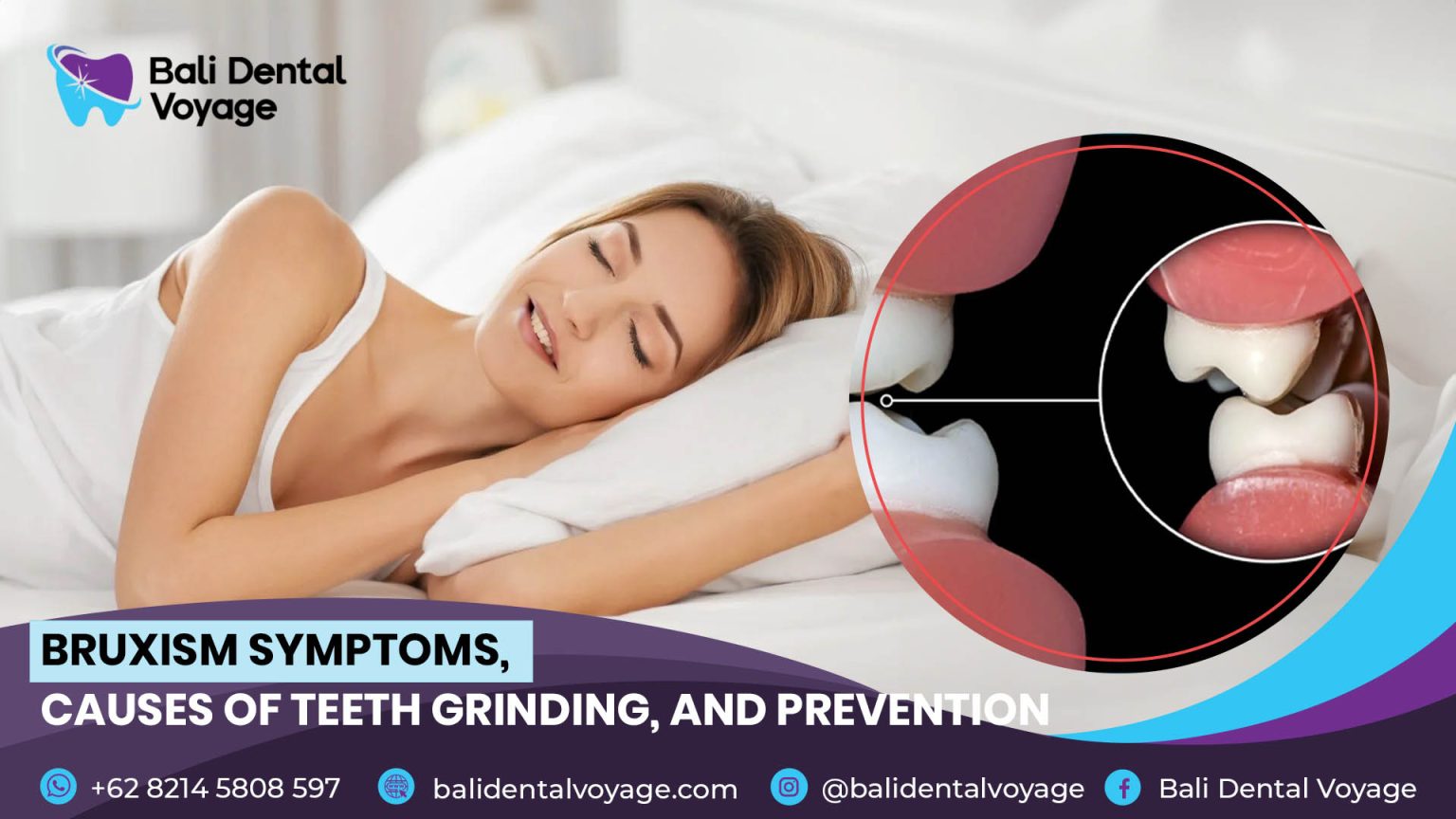 Bruxism Symptoms, Causes of Teeth Grinding, and Prevention