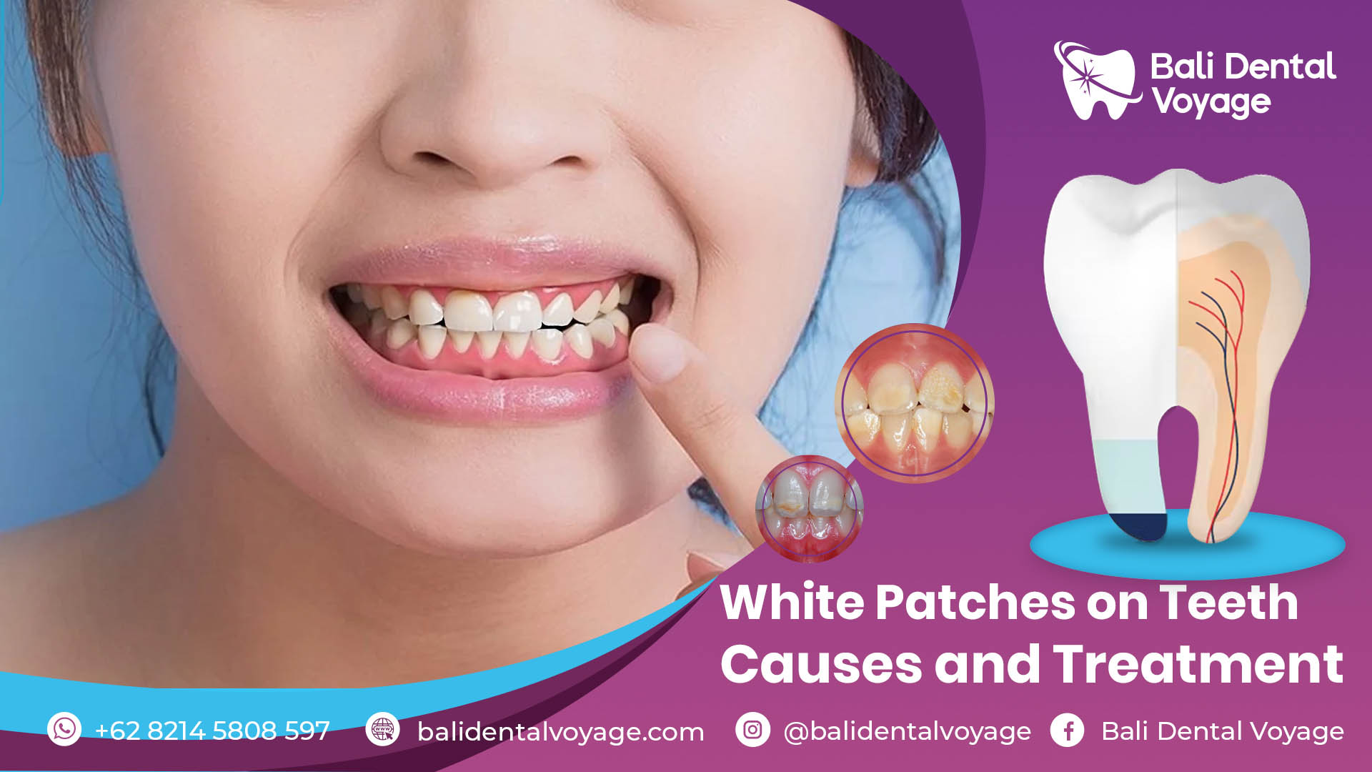 white patches on teeth