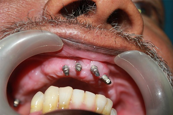 dental implant failure treatment