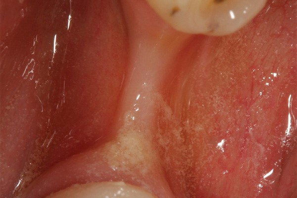 dental implant infection symptoms