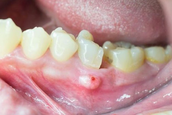 dental implants infections signs