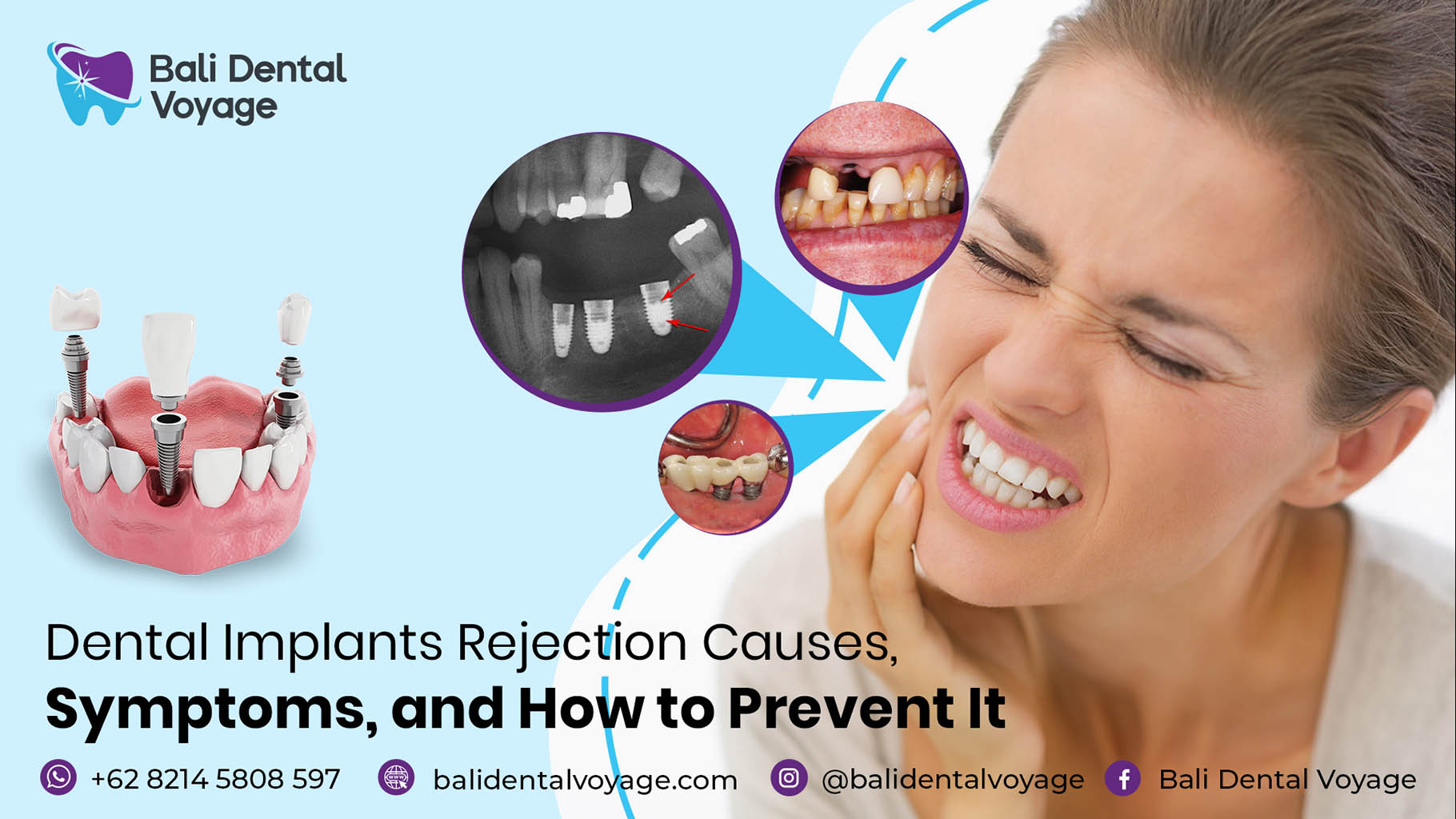 dental implants rejection