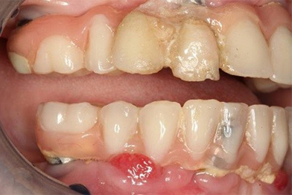 can dental implants get infected