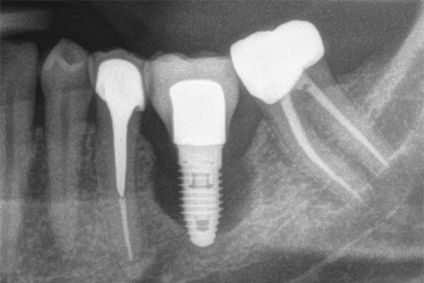what does an infected dental implant look like