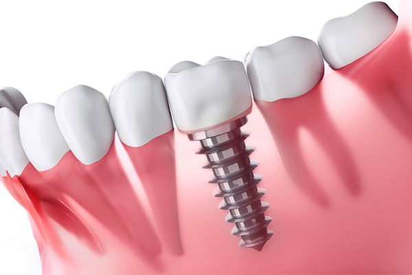 Dental Implants Price