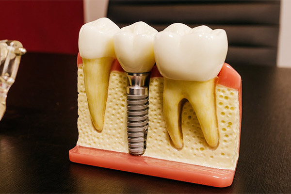 Tooth Implant Types
