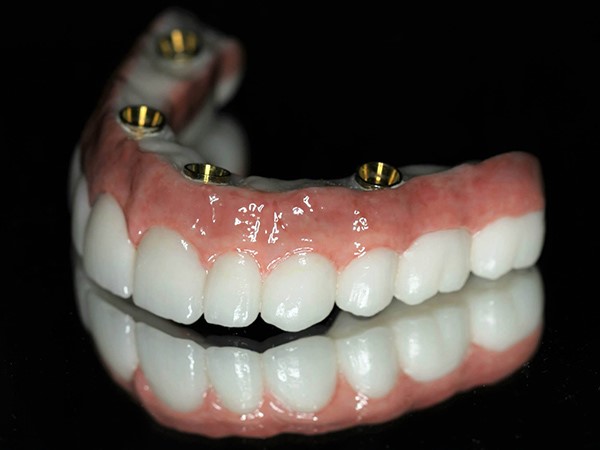 All-on-4 Dental Implants Cost Bali