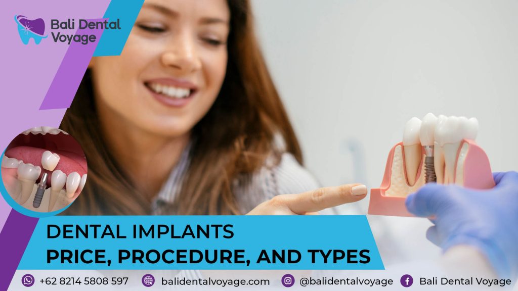 Dental Implants Price, Procedure, and Types | Bali Dental Voyage