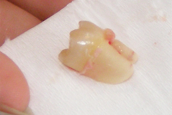 Extracted Tooth Replacement Options