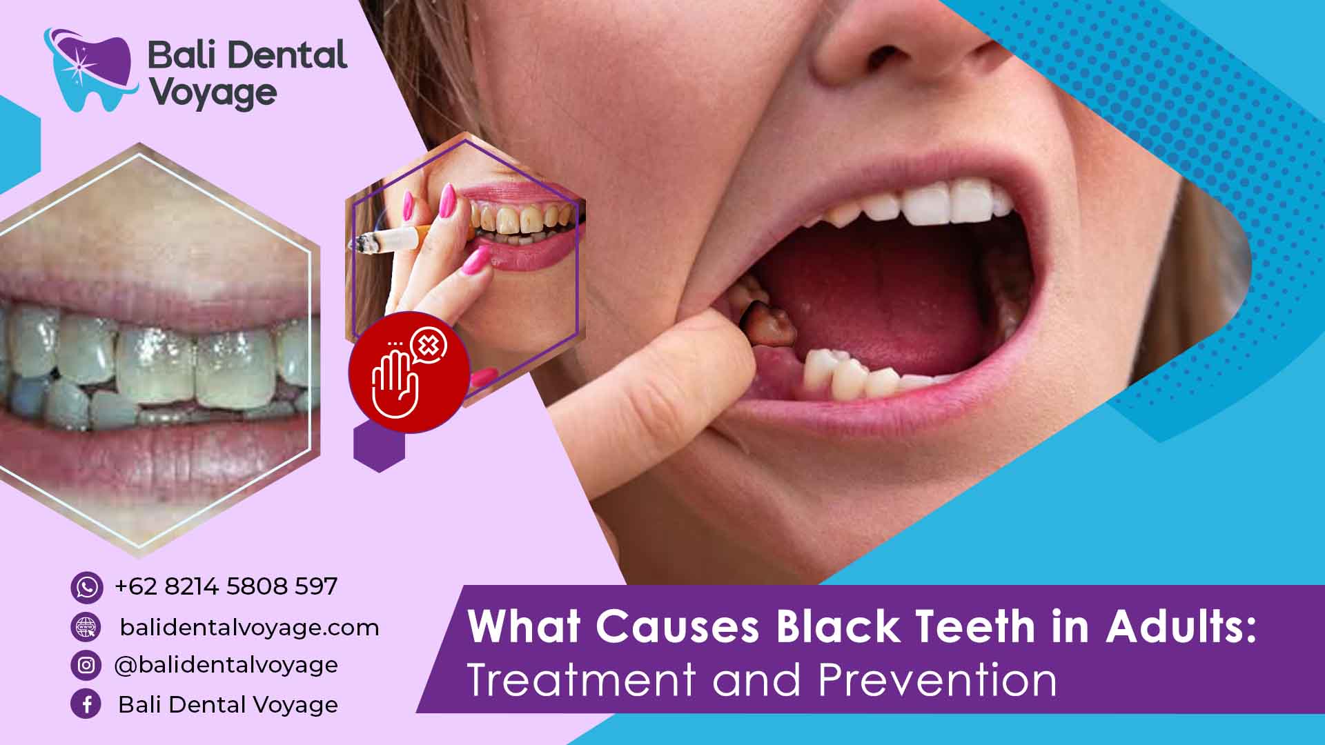 what causes black teeth in adults