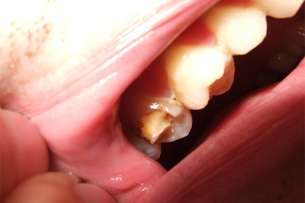 What Causes Cracked Tooth