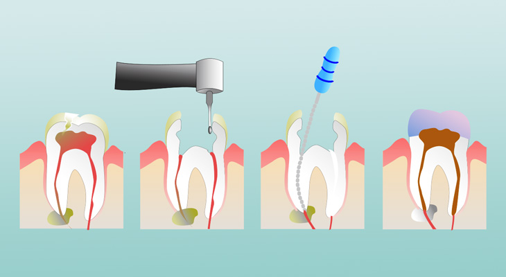 root canal treatment process